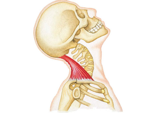 Illustrazione di infiammazione e dolore da artrite nella zona cervicale e delle spalle.