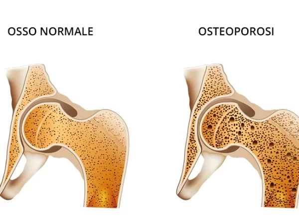 Rappresentazione della ridotta densità ossea tipica dell'osteoporosi a confronto con un osso sano.