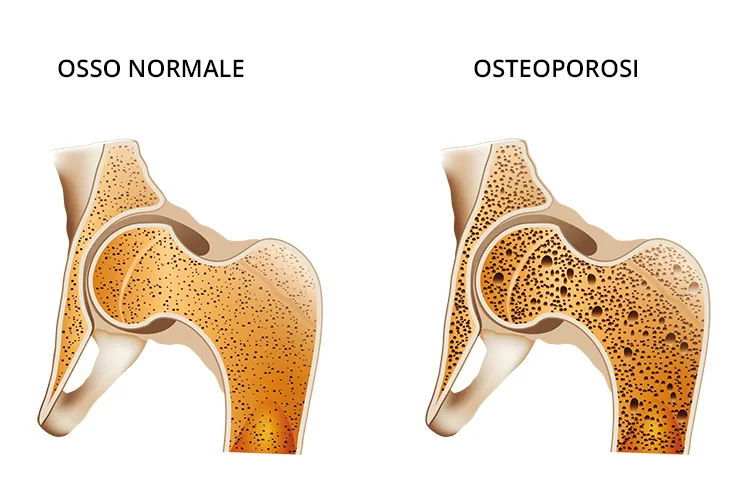 Rappresentazione della ridotta densità ossea tipica dell'osteoporosi a confronto con un osso sano.