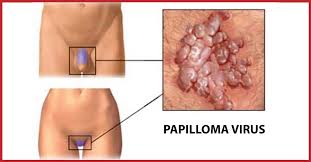 Illustrazione medica lesione da Papilloma Virus Umano - PROTOCOLLO INTENSIVO CONTRO IL PAPILLOMA VIRUS (HPV)