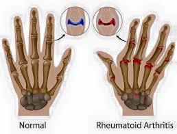 Infiammazione articolare delle mani e dei polsi - PROTOCOLLO PER L’ARTRITE REUMATOIDE