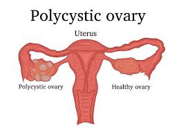 Illustrazione anatomica ovaio policistico - Sindrome PCOS e salute ormonale