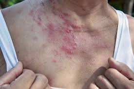 Eruzione cutanea da Herpes Zoster Fuoco di Sant'Antonio - Supporto immunitario