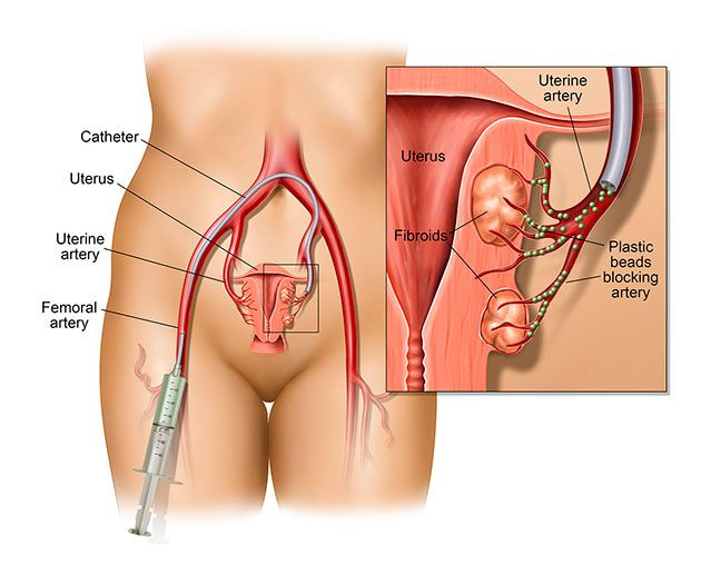 Anatomia utero con lesioni da endometriosi - Salute ormonale femminile