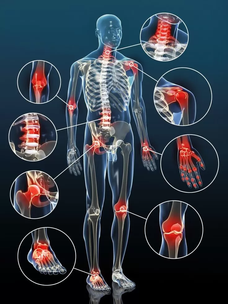 Articolazione del ginocchio con zone di infiammazione evidenziate - PROTOCOLLO ARTORFIX RAPID