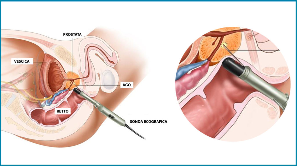 Anatomia della prostata e apparato urinario maschile - PROTOCOLLO PROSTAFIX