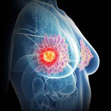 Illustrazione medica tumore al seno - Neoplasia mammaria e supporto oncologico