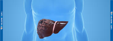 Illustrazione medica fegato umano con neoplasia - Oncologia epatica