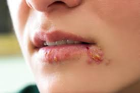 Rappresentazione virus Herpes Simplex - PROTOCOLLO HERPOX - per l'herpes genitale