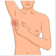 Illustrazione medica nodulo al seno e mastopatia - Salute femminile